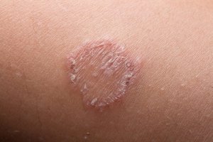 What's Ringworm and How You Treat It?