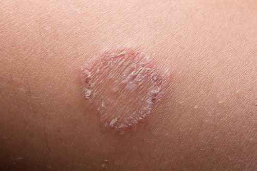 What's Ringworm and How You Treat It?