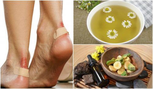 5 Natural Solutions to Alleviate Blisters on Your Feet 5 Natural Solutions to Alleviate Blisters on Your Feet