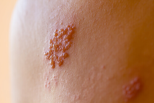 shingles symptoms