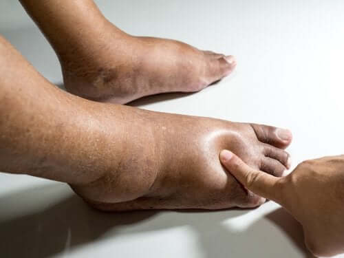 A person pressing on someone's swollen feet.