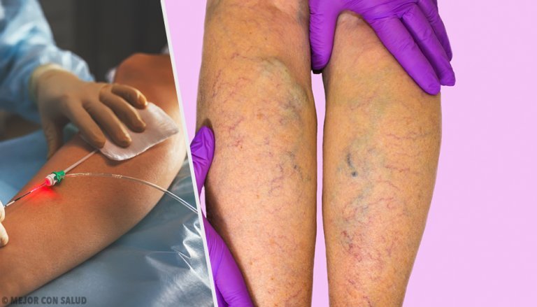 What Are Varicose Veins and How Are They Treated?