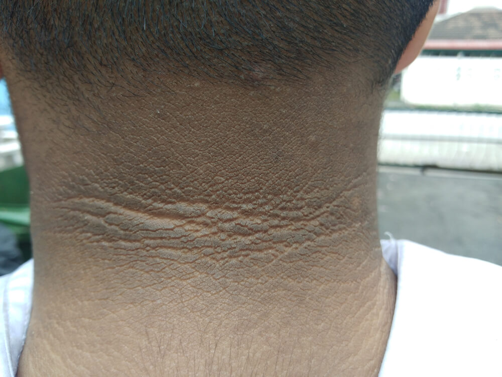 Dark Skin Spots On Neck