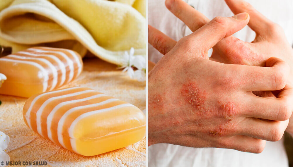 Homemade Glycerin, Propolis, and Clay Soap for Dermatitis Homemade Glycerin, Propolis, and Clay Soap for Dermatitis