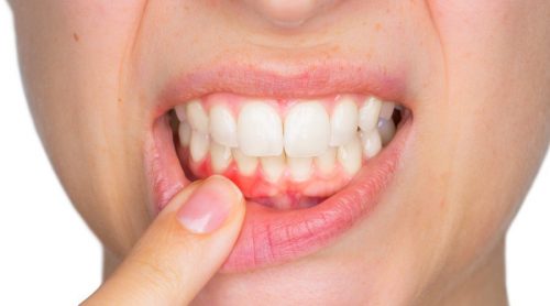 Pus