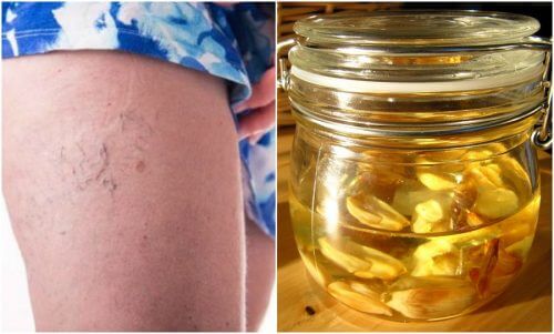 How to Make an Ointment to Reduce Spider Veins