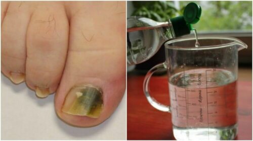 A Natural Alcohol Based Remedy Against Nail Fungus