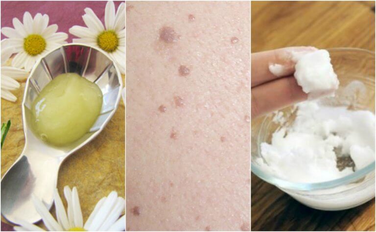 Five Treatments to Eliminate Flat Warts Five Treatments to Eliminate Flat Warts