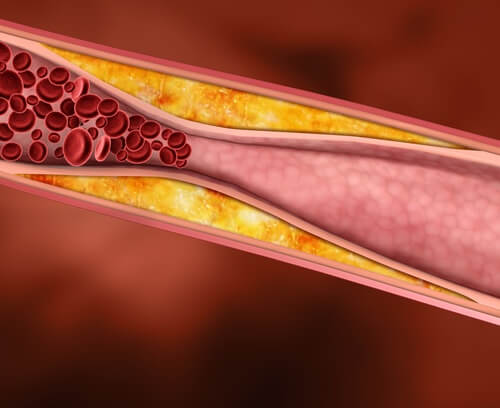 Cholesterol forming in the blood