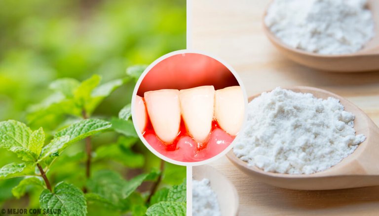 5 Effective Home Remedies for Gingivitis