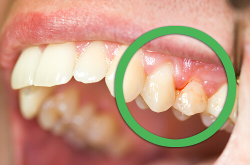 Gingivitis of the gums