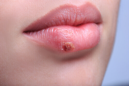 Herpes forming on lips