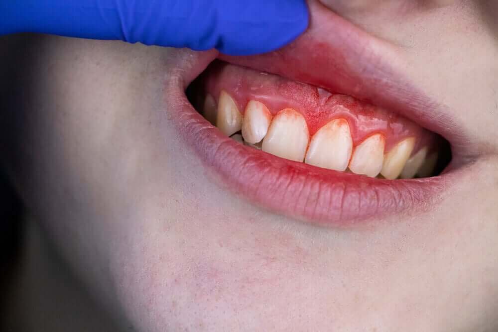 A person with swollen and bleeding gums.
