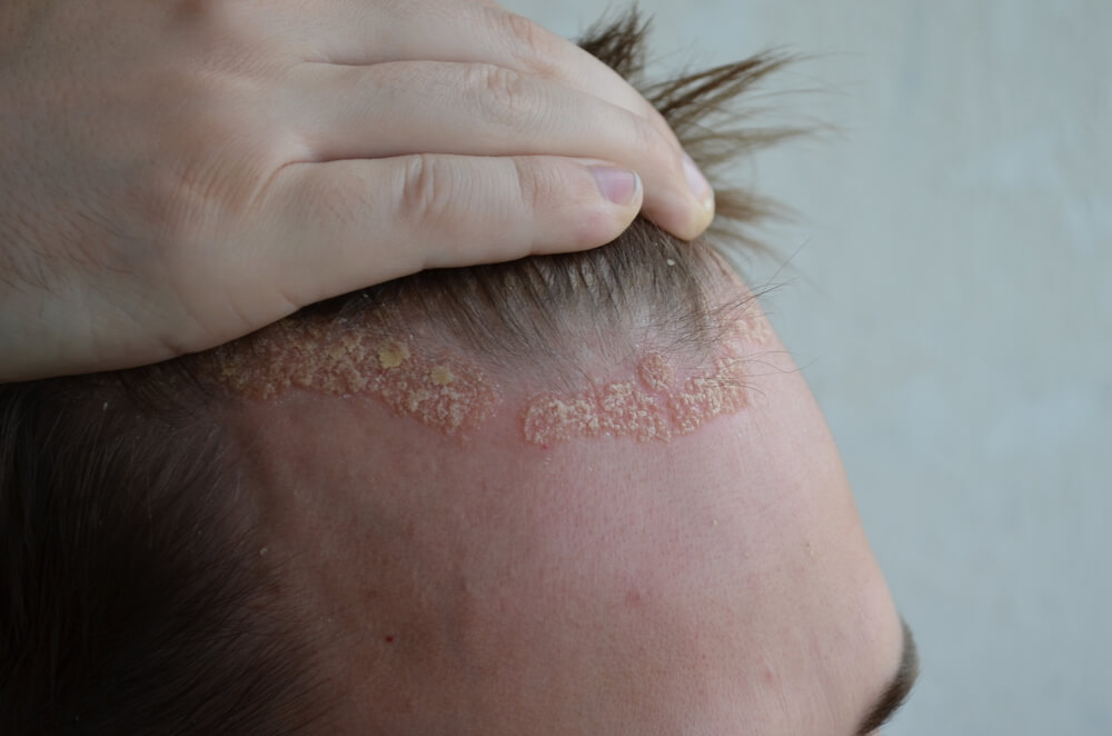 5 Home Remedies for Psoriasis of the Scalp Step to Health