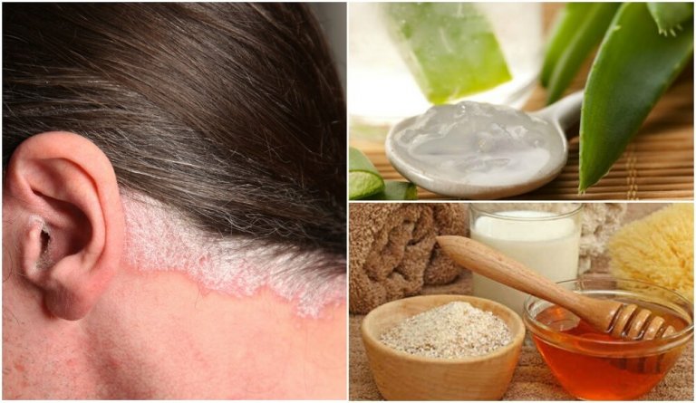 5 Home Remedies for Psoriasis of the Scalp