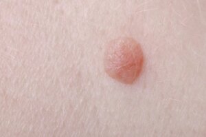 Five Treatments to Get Rid of Flat Warts