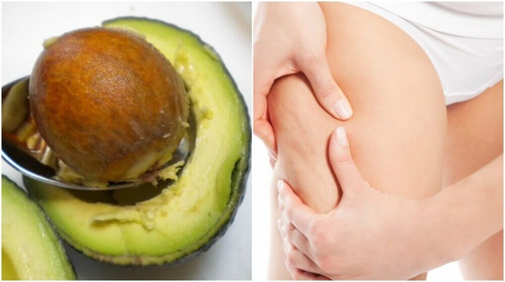 How to Use Avocado Seeds to Treat Cellulite How to Use Avocado Seeds to Treat Cellulite