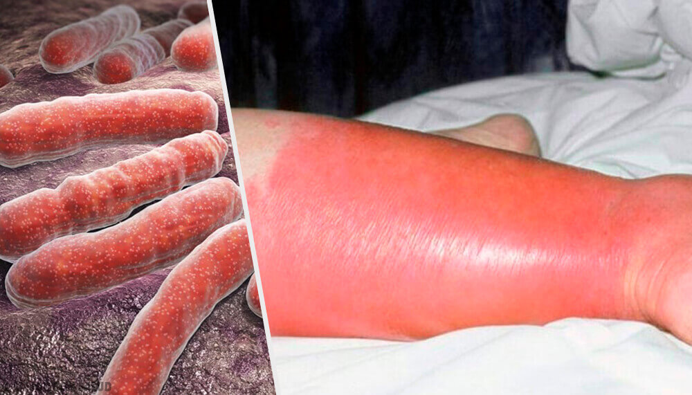 Erysipelas Infection: Problems and Solutions