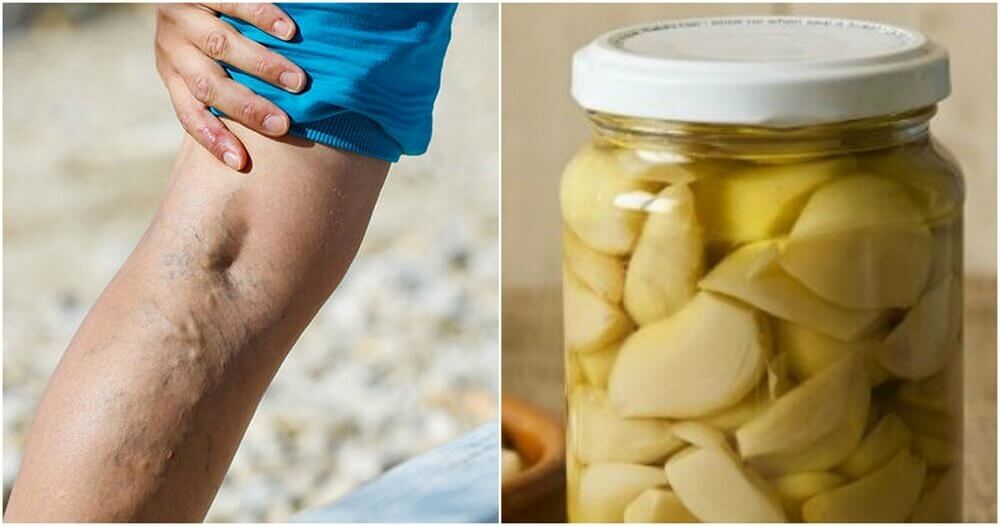 Garlic and Orange as Treatment for Varicose Veins