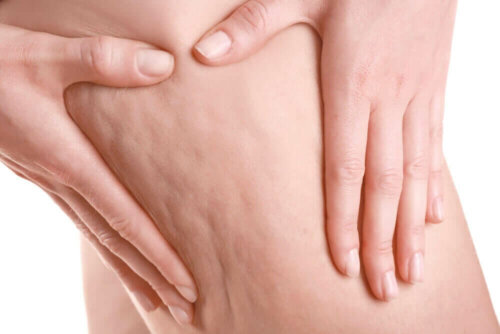 Some cellulite which is a sign of liquid retention.