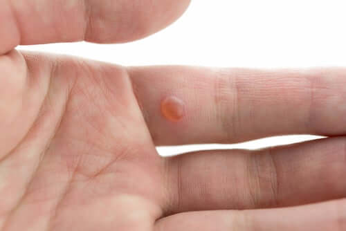 Some flat warts on a finger.