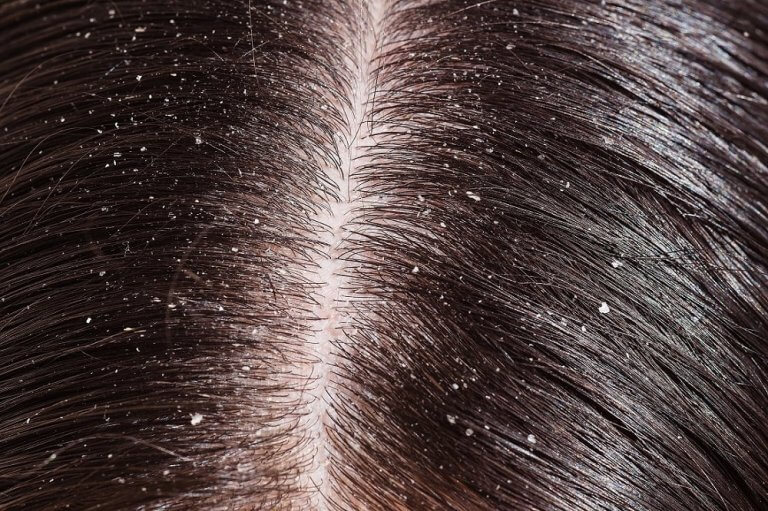 A head of hair with dandruff.