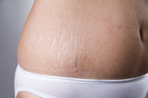 Stretch mark fighting cream