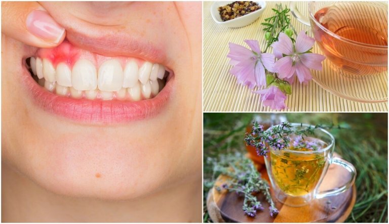 5 Natural Home Remedies for Gingivitis