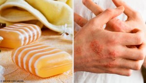 Homemade Glycerin, Propolis, and Clay Soap for Dermatitis
