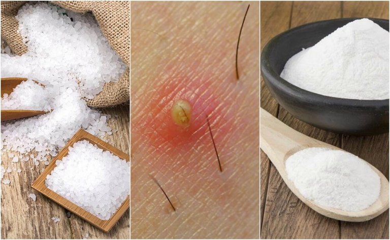 Five Natural Solutions for Ingrown Hairs