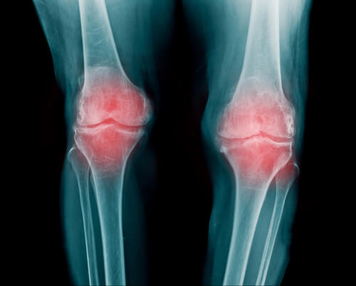 An x-ray of knees