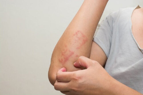 A person with a rash.