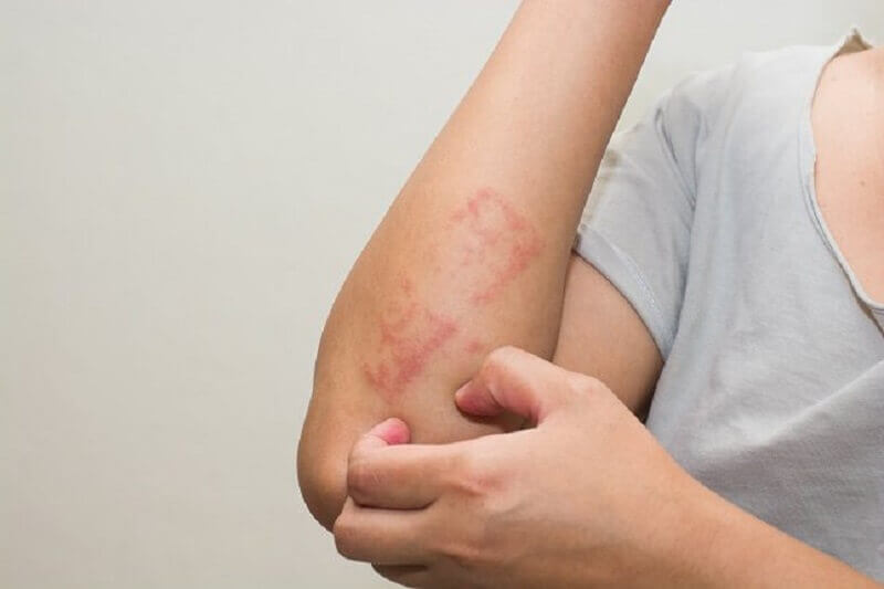 does leukemia rash itch