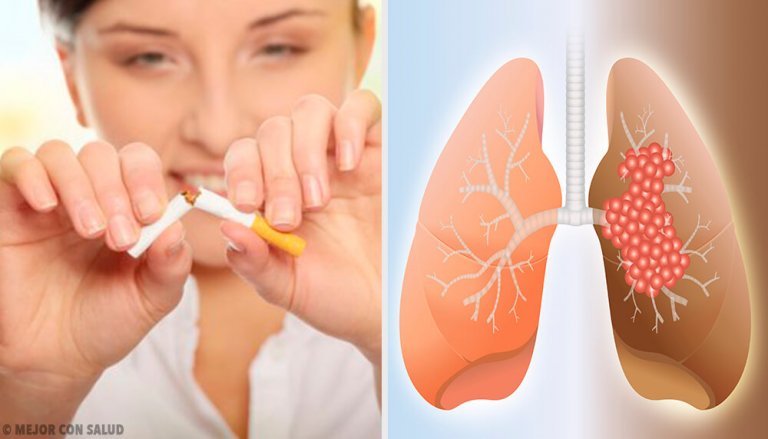 The Causes and Diagnosis of Lung Cancer