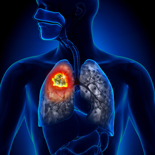 폐암의 유형