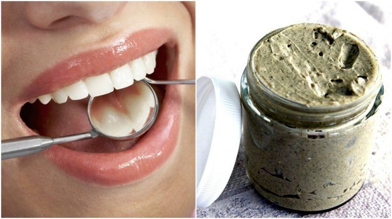 How to Treat and Prevent Cavities the 100% Natural Way