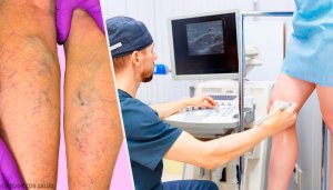 Natural Topical and Oral Treatments for Varicose Veins