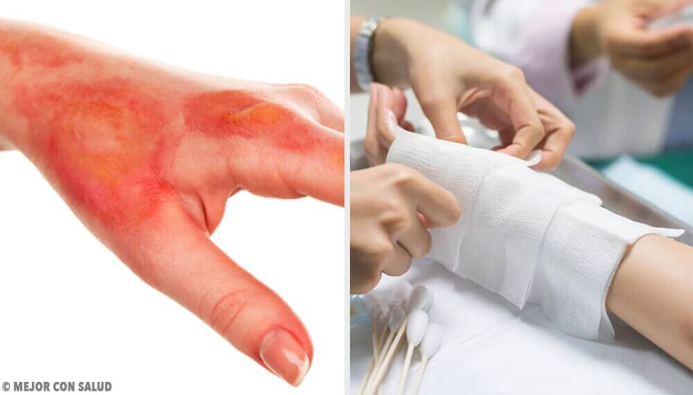 What to Do after a Burn