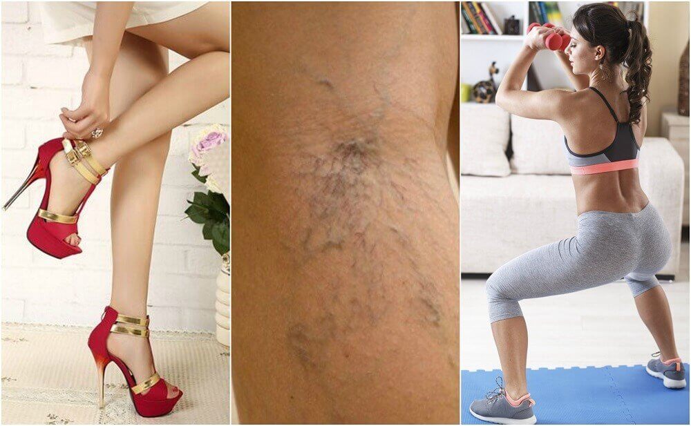 10 Tips To Help You Avoid Varicose Veins