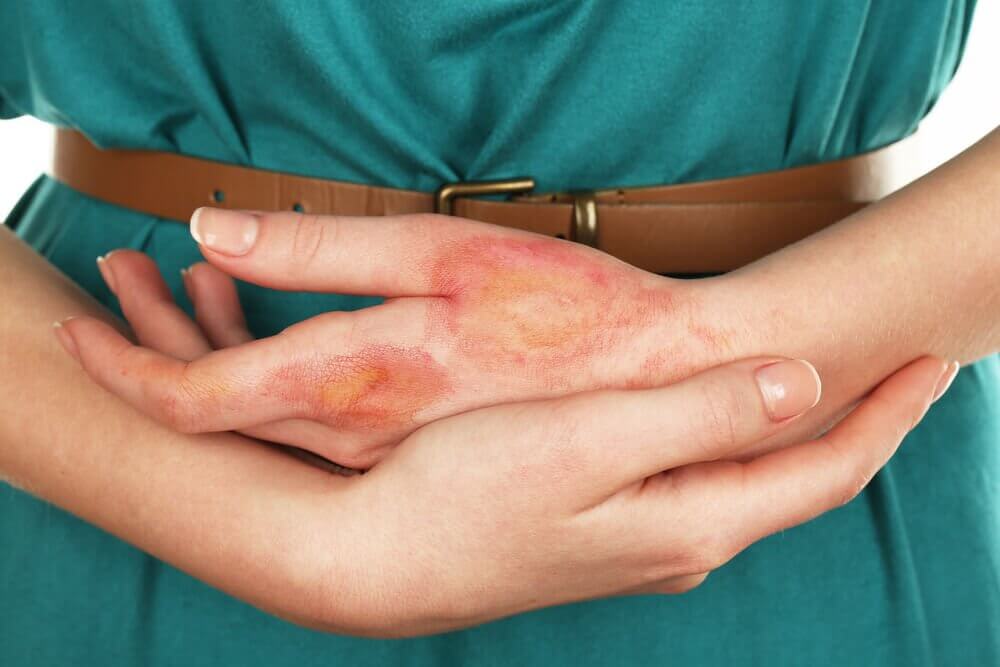 Things not to do in the event of a burn