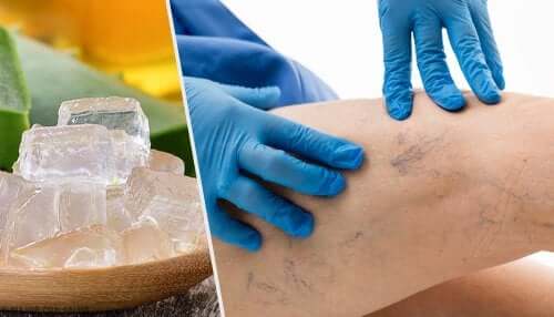 Five Alternative Treatments for Varicose Veins