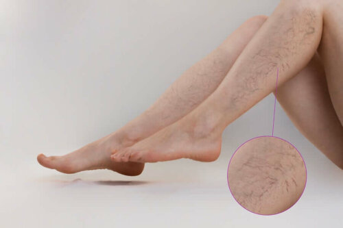 A person that needs some alternative treatments for varicose veins.