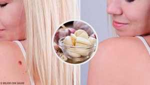 9 Ways to Remove Warts Quickly