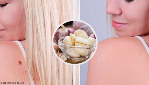 9 Ways to Remove Warts Quickly
