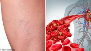 The 3 Best Home Remedies for Phlebitis