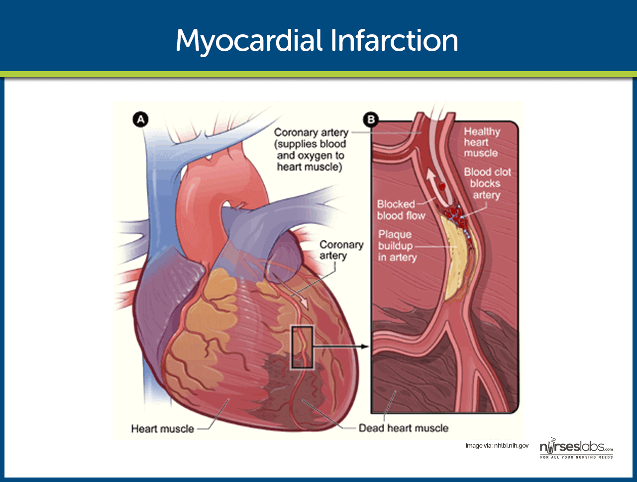 heart with myocardial infarction