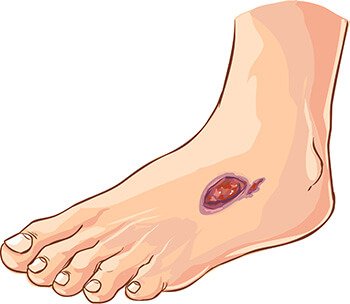 Amputations