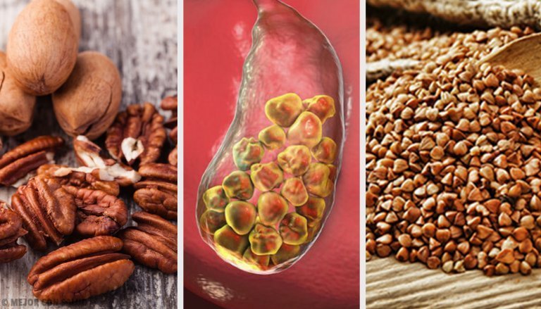 6 Foods to Help Fight Gallstones