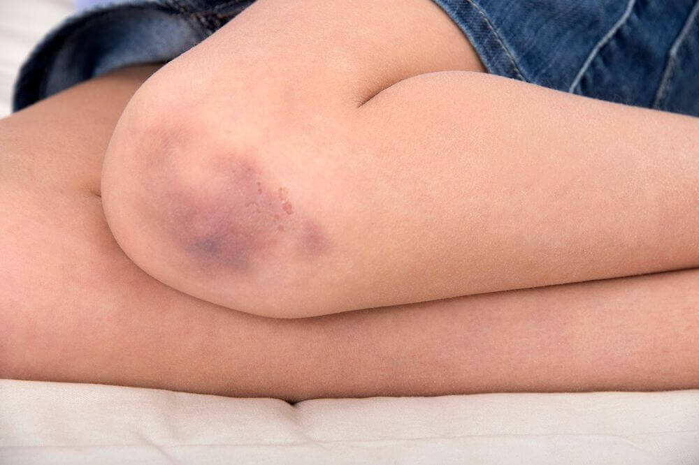 Vaseline-remedy-for-contusions