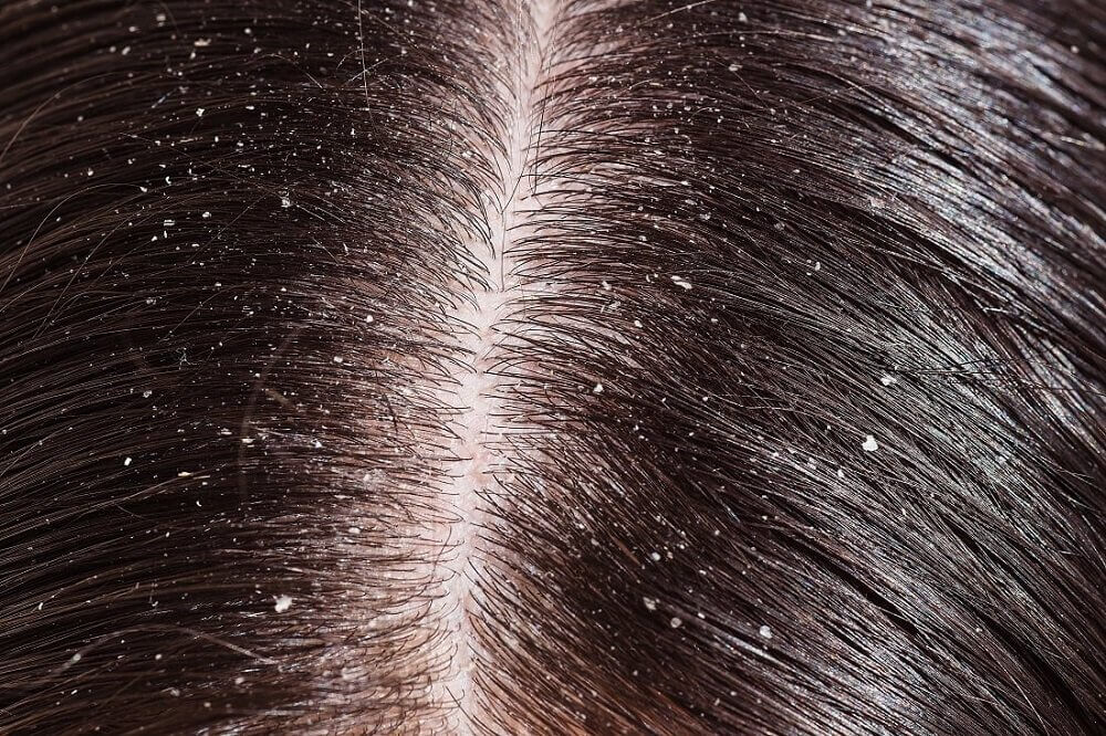 Dandruff on scalp